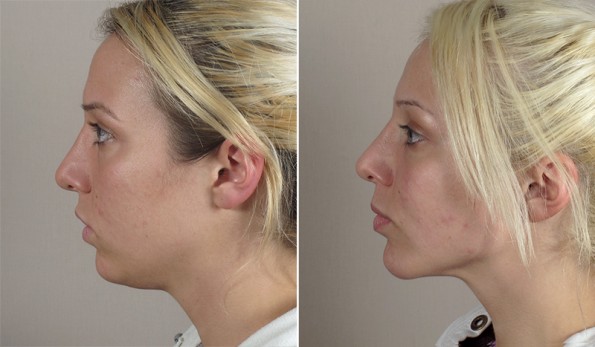 New Jersey Chin Implant with Neck Contouring