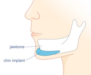 Chin Implant Diagram