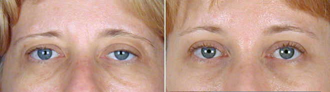 New Jersey Eyelid Surgery