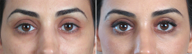 New Jersey Upper & Lower Eyelid Lift