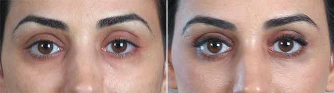 New Jersey Upper & Lower Eyelid Lift