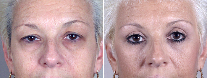 New Jersey Upper & Lower Eyelid Lift