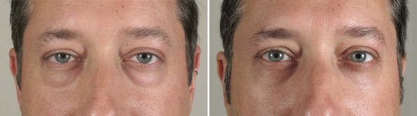 Male patient before and after lower blepharoplasty