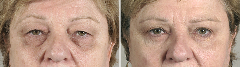 New Jersey Upper & Lower Eyelid Lift