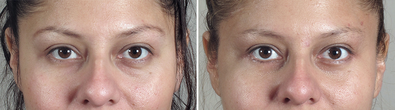 New Jersey Eyelid Surgery