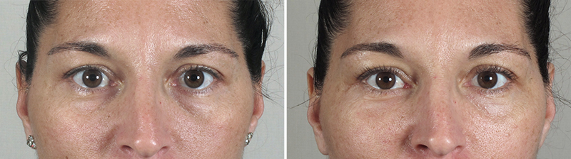 New Jersey Eyelid Surgery