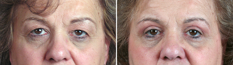 New Jersey Eyelid Surgery