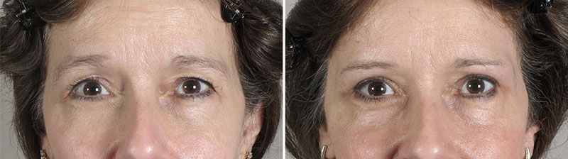 New Jersey Eyelid Surgery