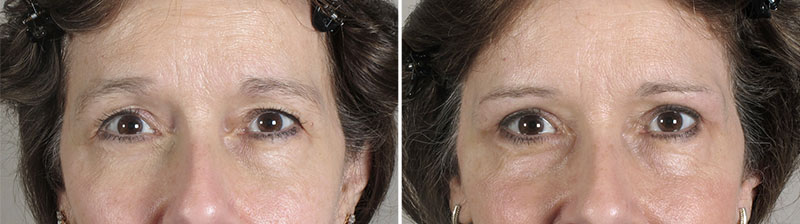 New Jersey Eyelid Surgery