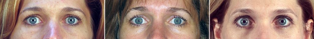 Lower Eyelid Surgery Results Age Naturally with You