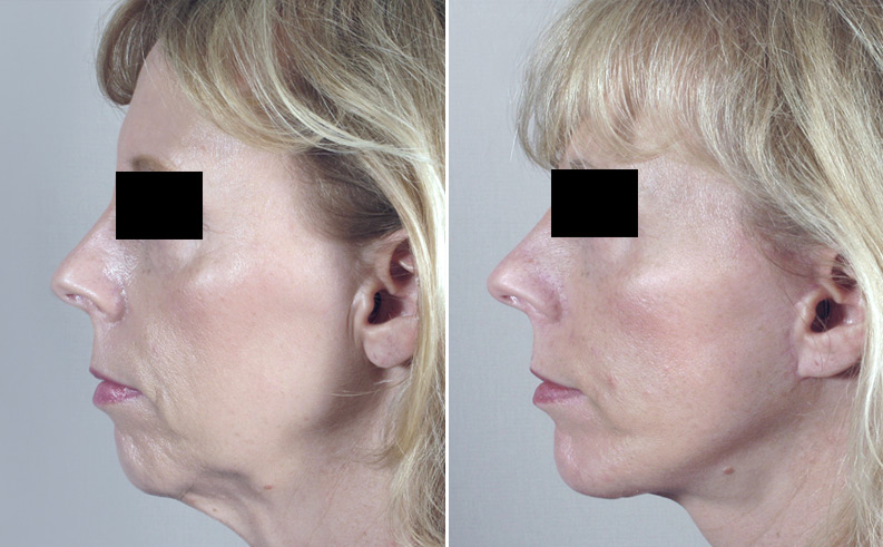 Chin Augmentation New Jersey Before and After