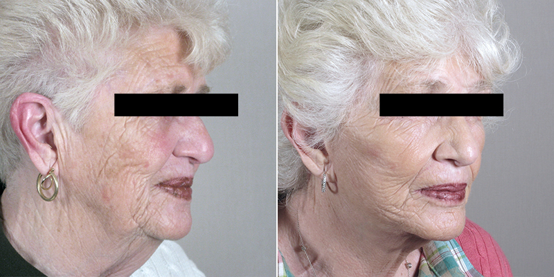 Side view of older woman before and after facelift