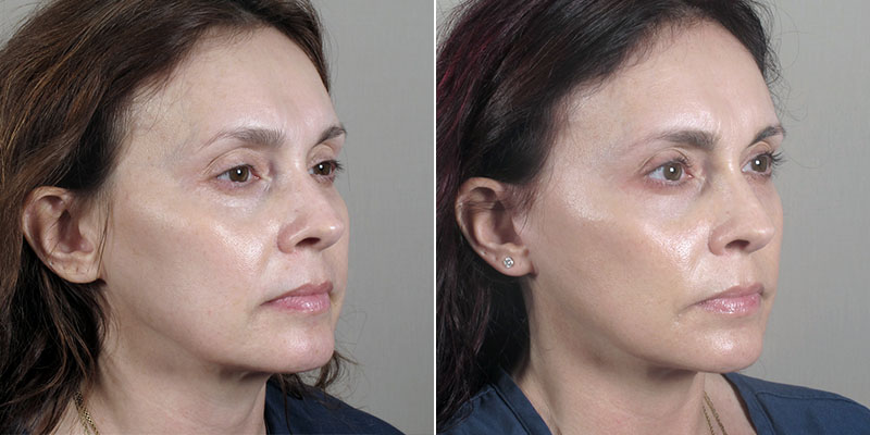 Side view of woman before and after mini facelift