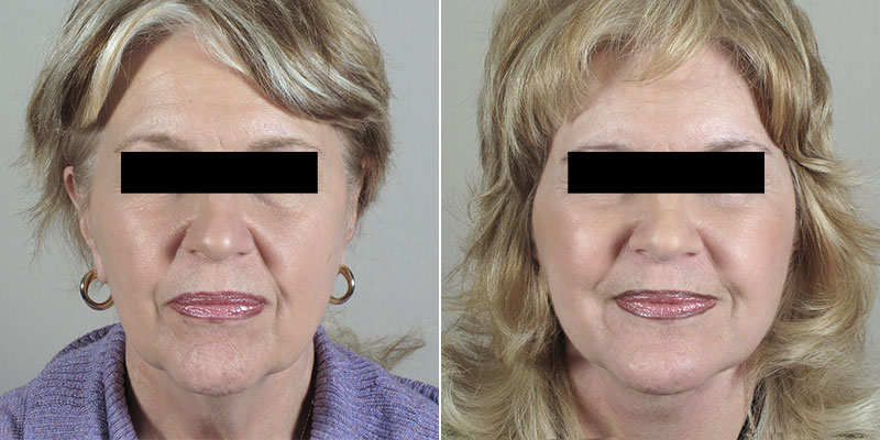 Facelift and Neck Lift New Jersey Before and After
