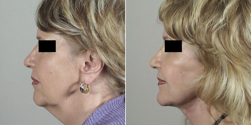 Facelift and Neck Lift New Jersey Before and After