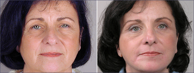 Front view of woman before and after facelift