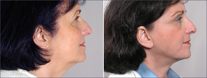 Side view of woman before and after facelift