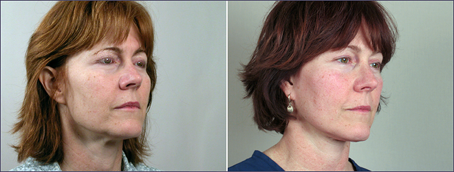 Side view of woman before and after facelift