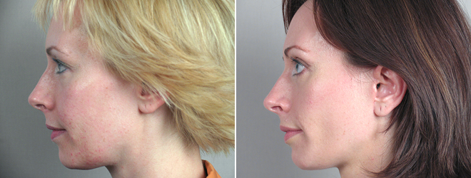 Side view of woman before and after facelift