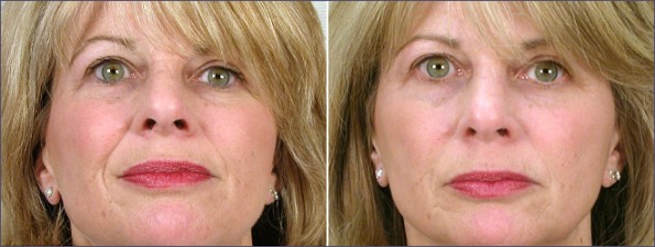 Front view of woman before and after dermal fillers