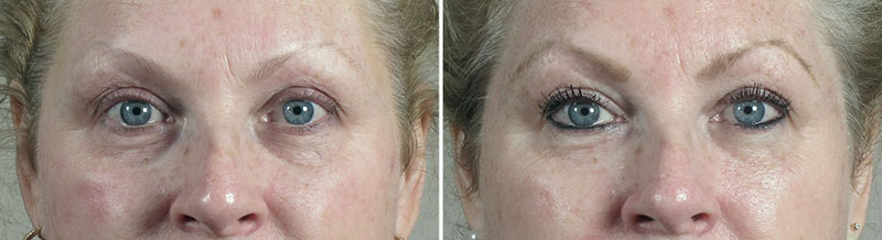 Before & After Halo Hybrid Fractional