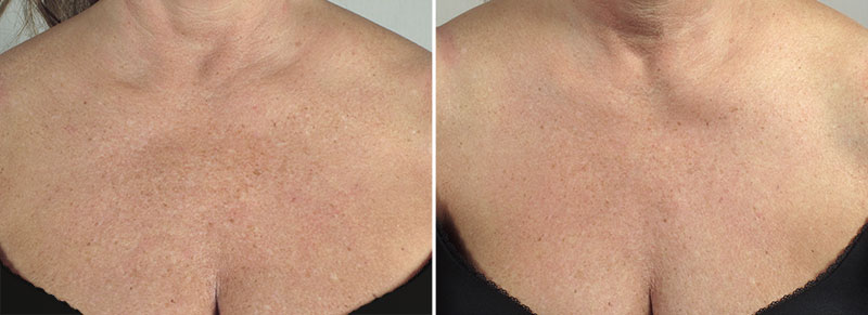 Before & After Halo Hybrid Fractional
