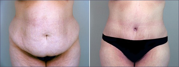 New Jersey Lipoabdominoplasty