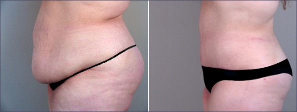 New Jersey Lipoabdominoplasty