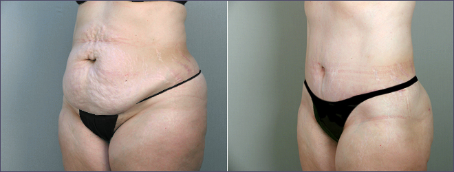 Before & After: Parker Tummy Tuck