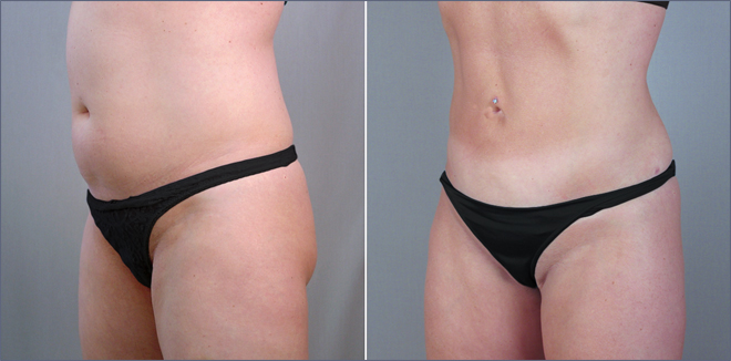 New Jersey Tummy Tuck Image