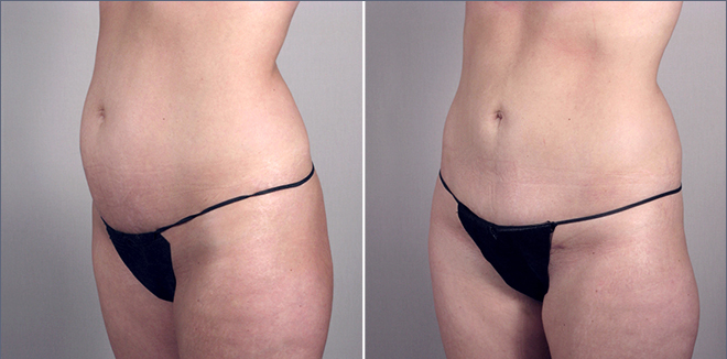 New Jersey Tummy Tuck Image