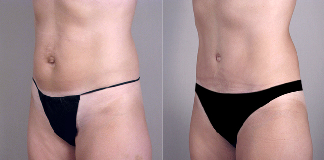 New Jersey Tummy Tuck Image