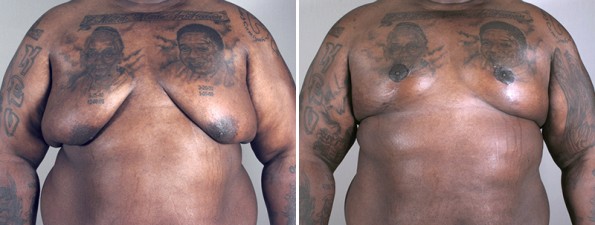 Before & After: Circumvertical Chest Lift