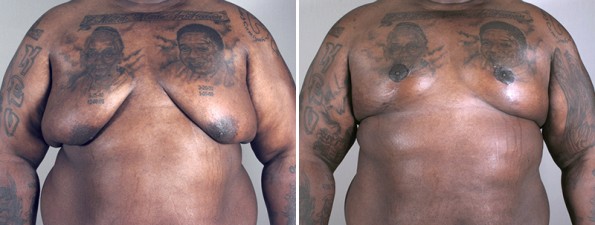 Male Breast Reduction (Chest Lift) in Paramus, NJ