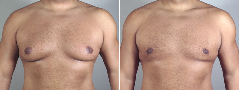 New Jersey Gynecomastia