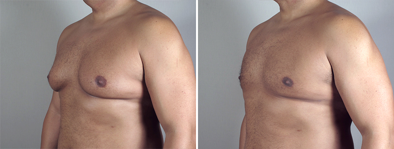 Male Breast Reduction (Chest Lift) in Paramus, NJ