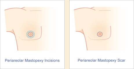 Male periareloar mastopexy incision and scar