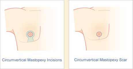 Male circumvertical mastopexy incision and scar