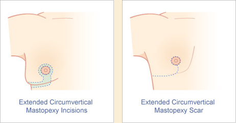 Male extended circumvertical mastopexy incision and scar