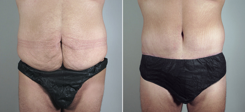 Male patient before and after lipoabdominoplasty