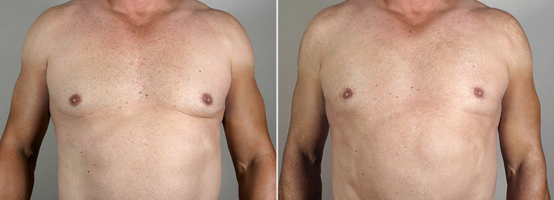 New Jersey Gynecomastia Reduction