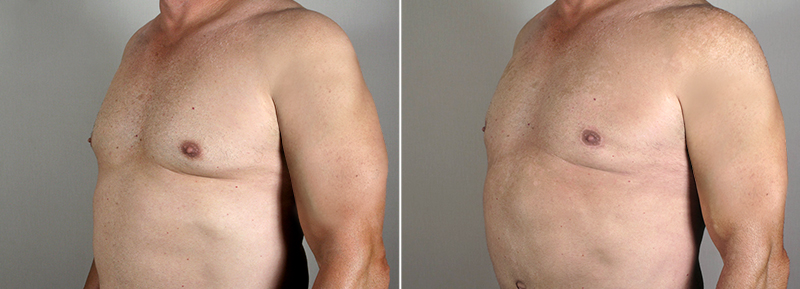 New Jersey Gynecomastia Reduction