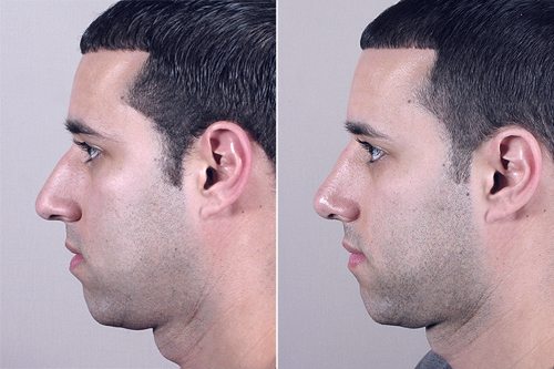 Male before and after rhinoplasty procedure