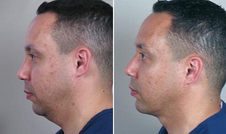 Chin Augmentation for Men Before and After