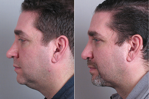 Rhinoplasty New Jersey Image