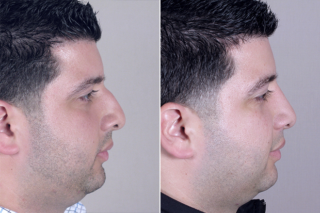 Rhinoplasty New Jersey Image