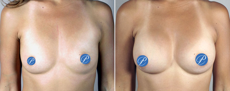 Breast Augmentation to Correct Asymmetry