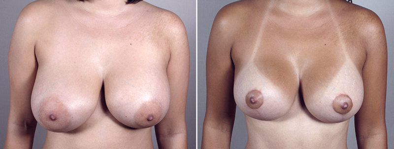 Front view of woman\'s chest before and after breast revision surgery