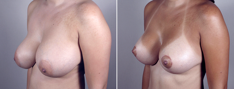 Side view of woman\'s chest before and after revision breast augmentation surgery