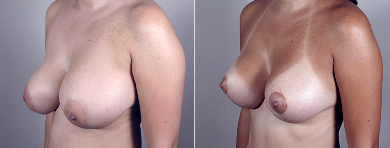 Side view of woman\'s chest before and after breast revision surgery